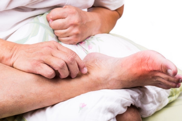 Các dấu hiệu nhận biết bệnh gout